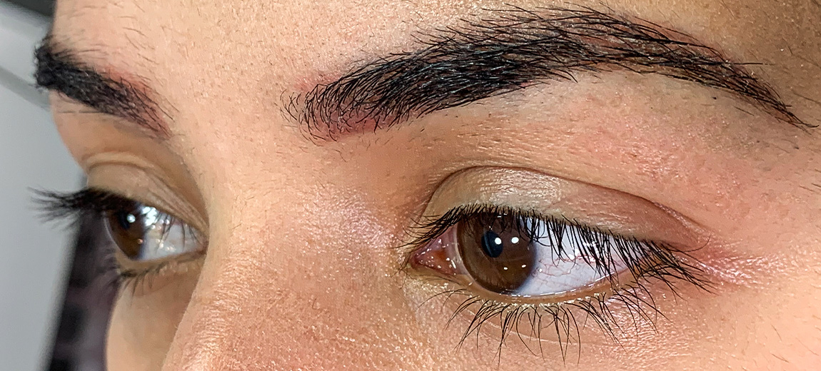 Olhos - Antes - 2